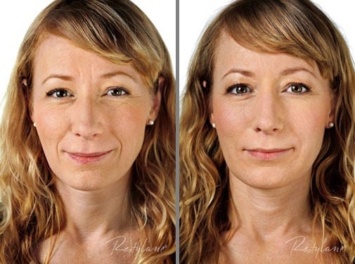 restylane newington