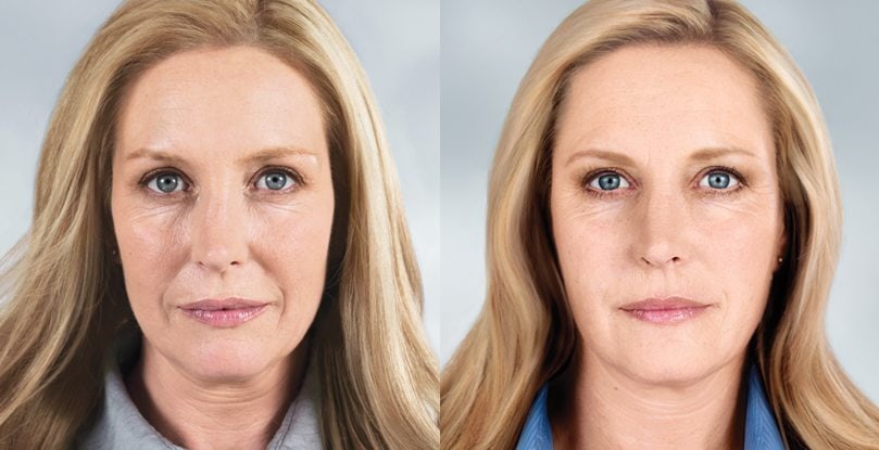 sculptra-before-and-after-renu180-medspa-southington-ct