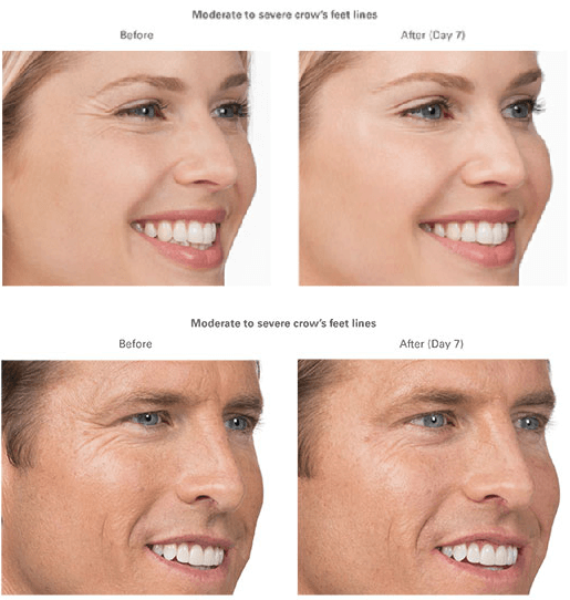 Botox Treatment Areas