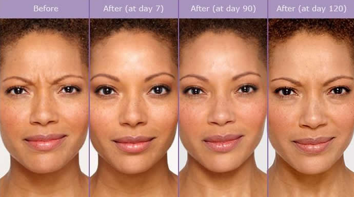 Botox treatment areas Southington
