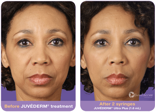 juvederm-before-after-3